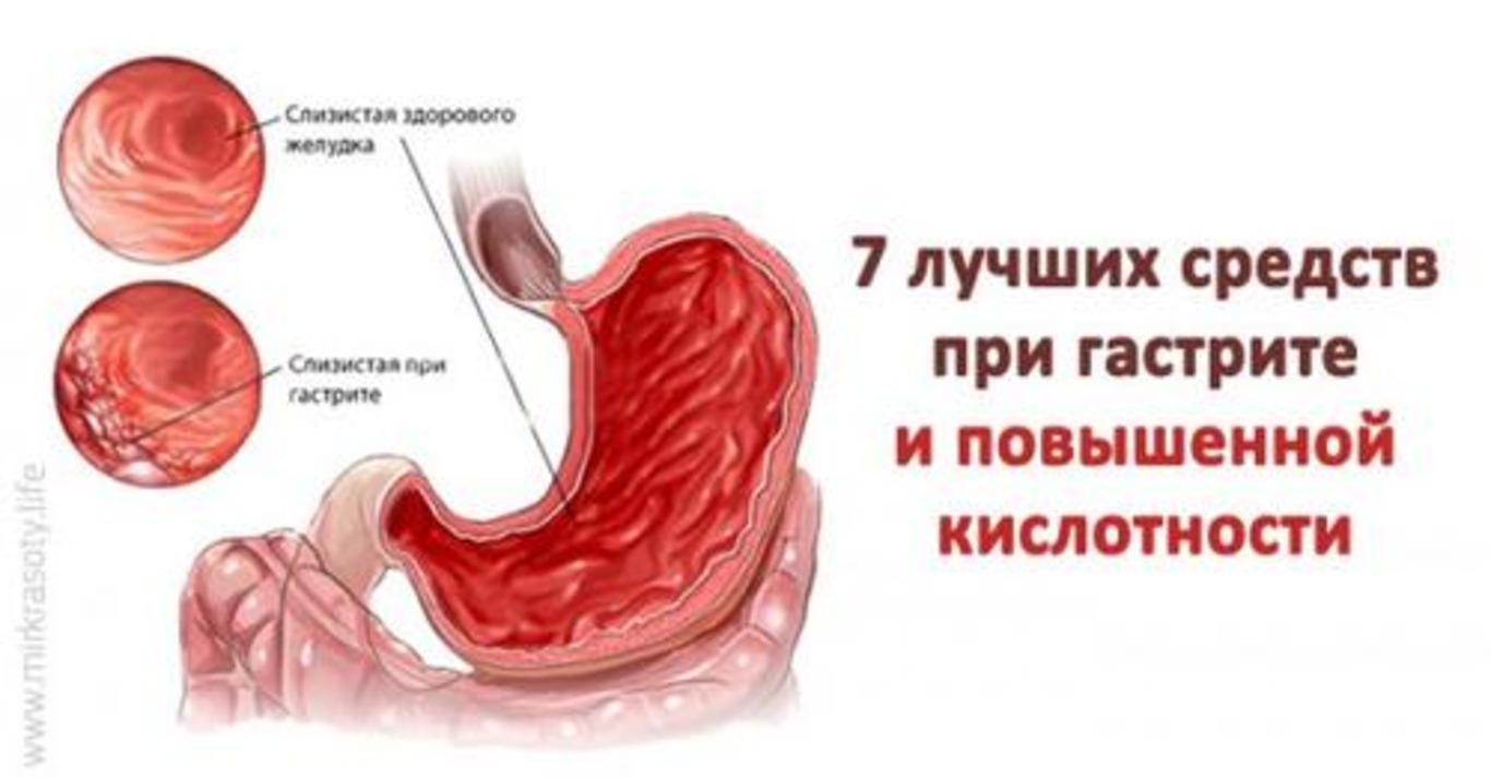 Симптомы повышенной кислотности желудка у взрослых. Желудок с повышенной кислотностью. Повышенное кислотообразование в желудке. Повышенная кислотность желудка. Гастрит повышенная кислотность.